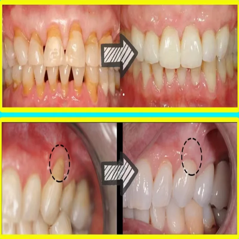 Quickly Repair Gum Serum Relie - Teeth Whitening With Baking Soda 评论和价格