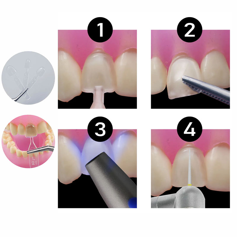 32pcs/Set Composite Resin Mold - Teeth Whitening Moulds 评论和价格