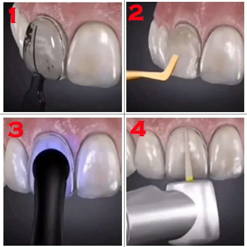 Dental Mould For Composite Res - Teeth Whitening Moulds 评论和价格