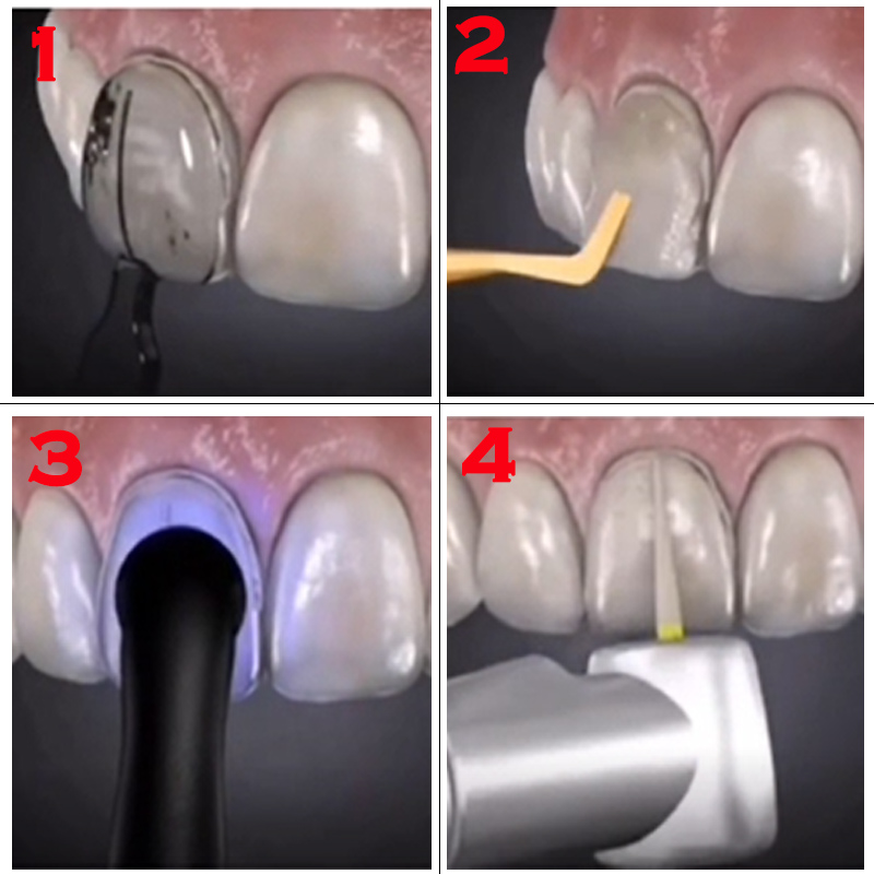 32pcs Dental Veneer Mould Kit  - Teeth Whitening Moulds 评论和价格