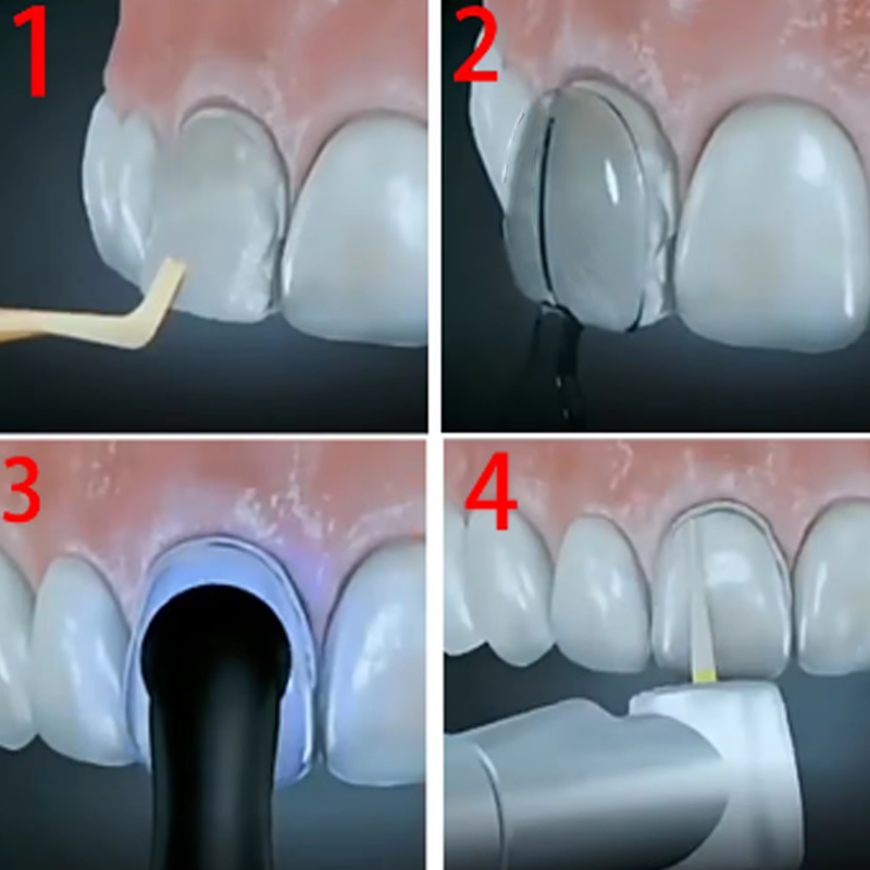 32Pcs/Box Dental Veneer Mould  - Teeth Whitening Moulds 评论和价格
